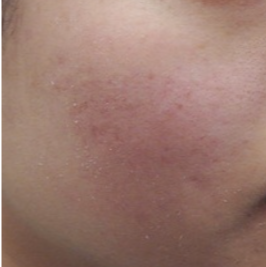 microneedling - Dermapen 4 MD